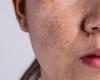 تعرف على أسباب ظهور الطفح الجلدي على الوجه - بوراق نيوز